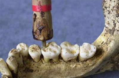 Історія зубних коронок